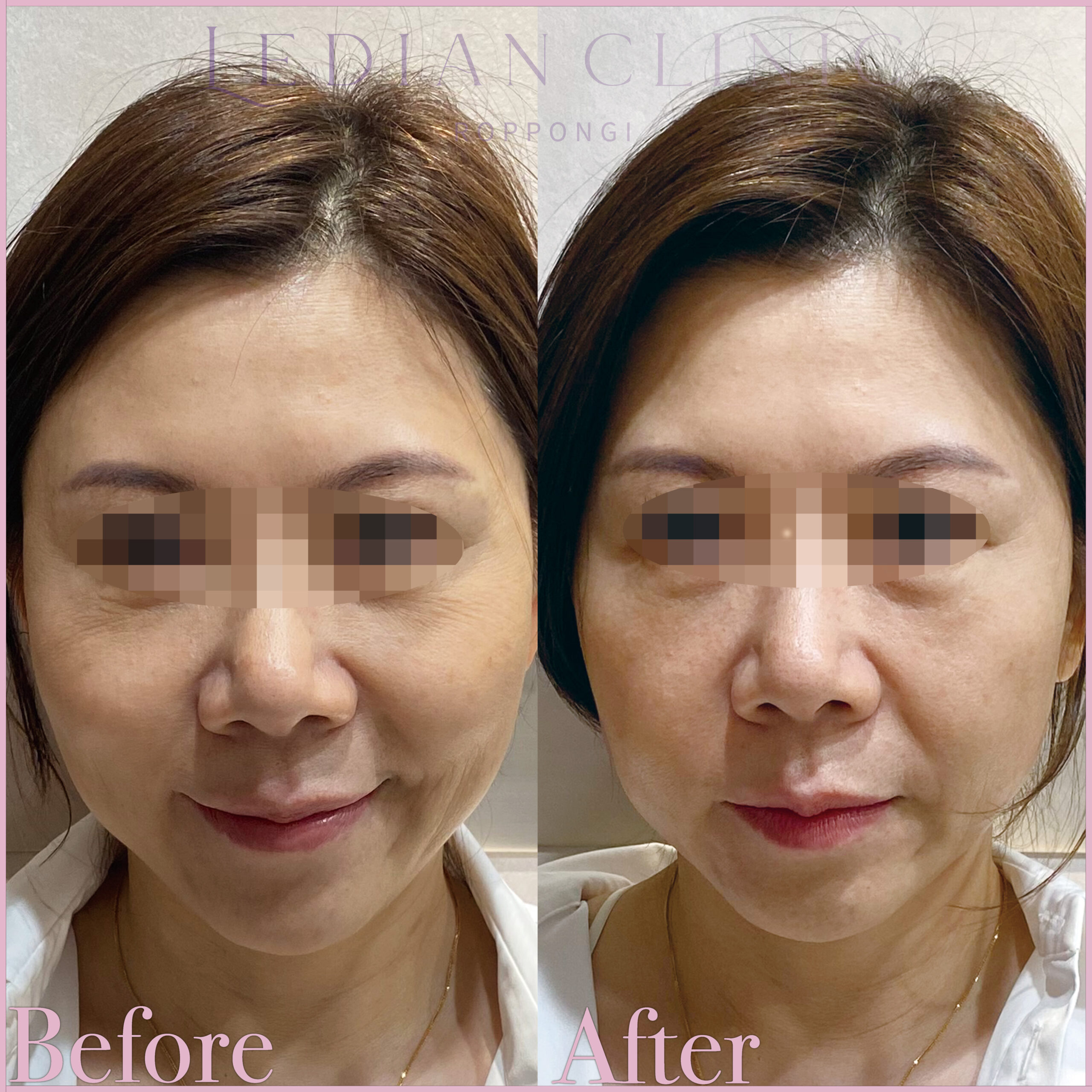 HIFU ウルトラセルZi | Ledian Clinic（レディアンクリニック六本木