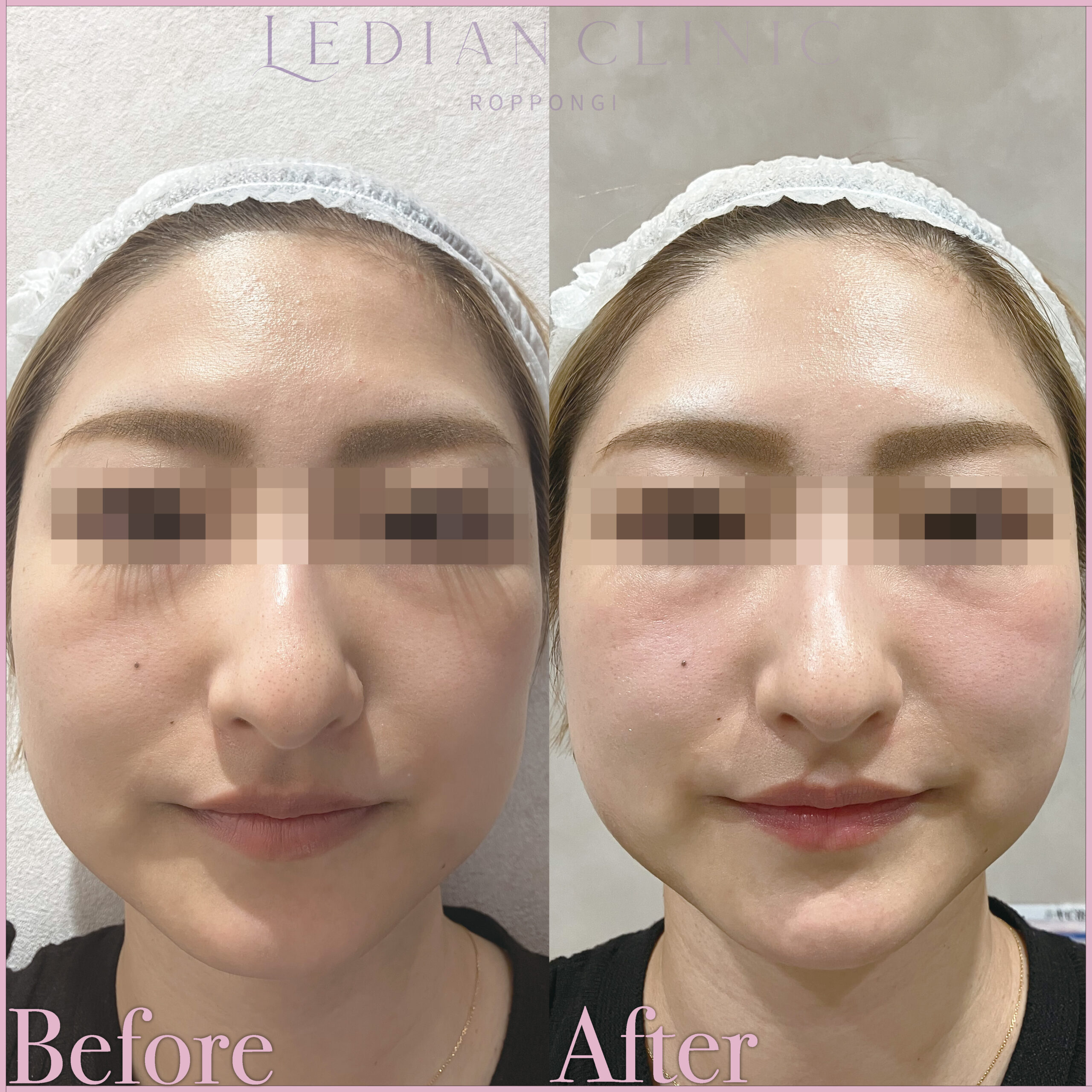 【症例Before/After】1ヶ月後 アフター写真となります。
