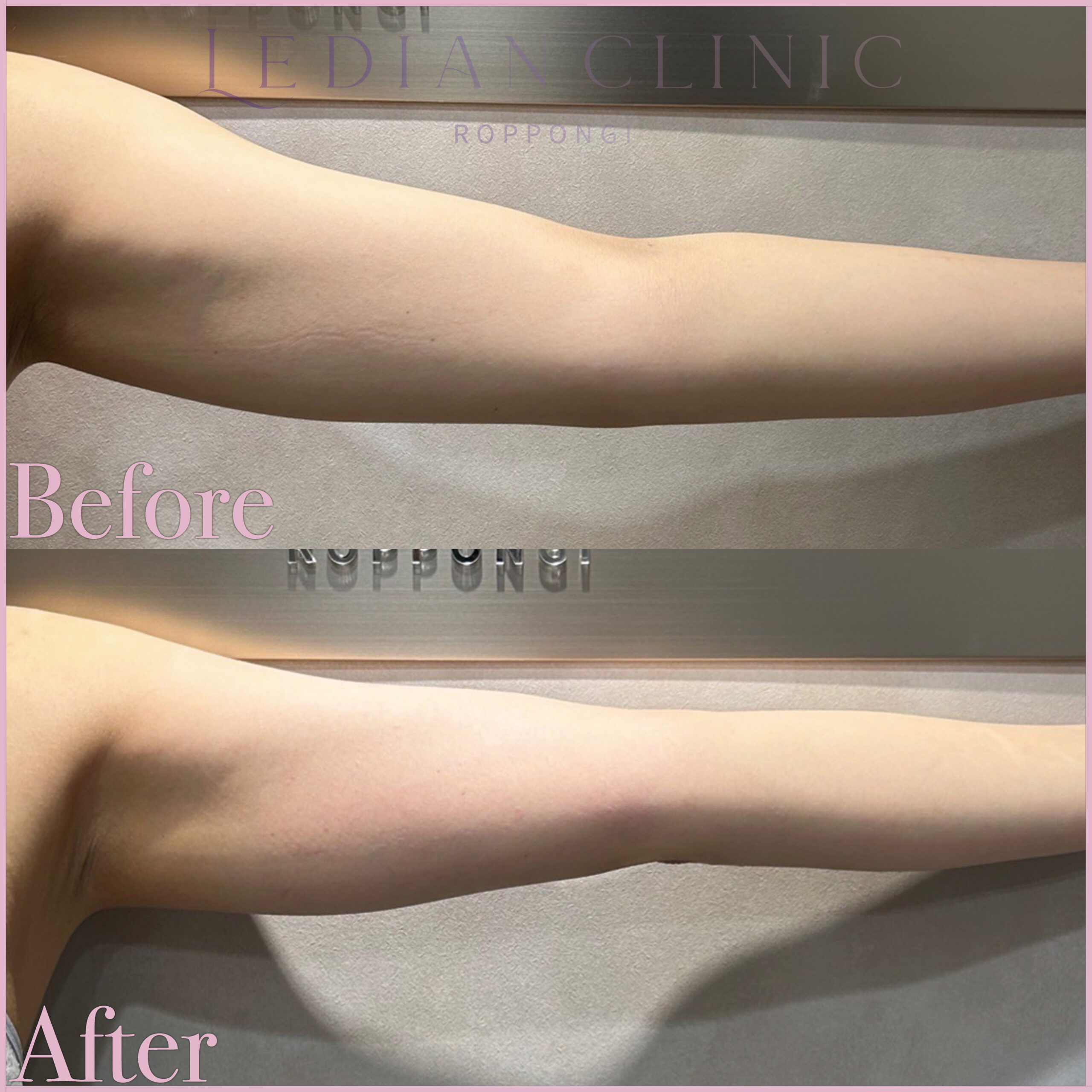 【症例Before/After】1ヶ月後 アフター写真となります。
