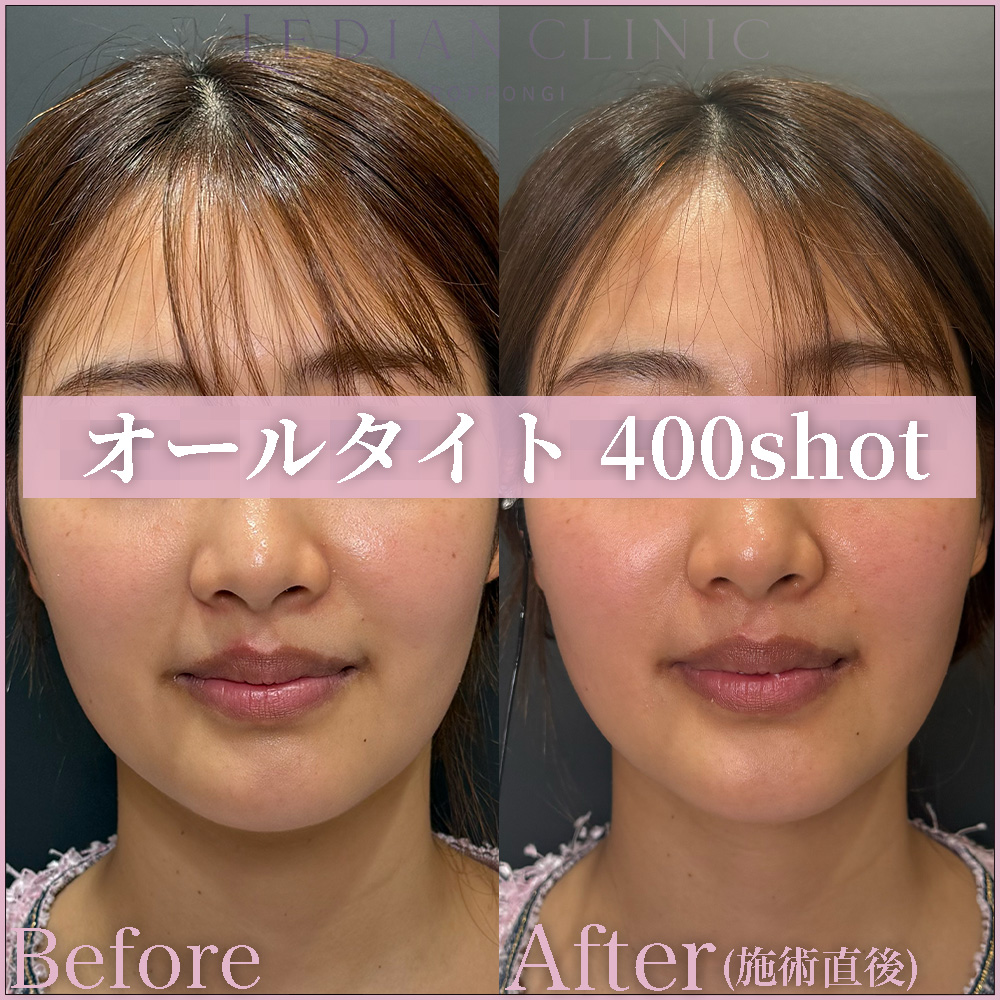 【症例Before/After】オールタイトを両頬300shot、顎下50shot、首左右50shot照射しました。
DLTD®(誘電加熱)技術により、真皮層からSMAS層へ熱エネルギーを届け、コラーゲンの収縮・再構築を促します。
フェイスラインや顎下、首のもたつきを引き締め、輪郭をすっきりと整えながら、肌のハリ・弾力の向上を目的とした治療です。