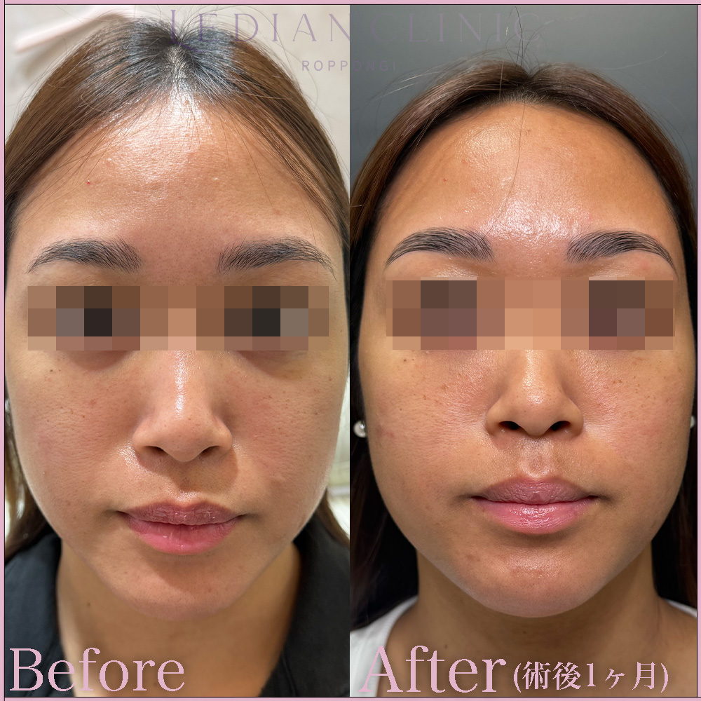 【症例Before/After】ジュベルックは、肌のコラーゲン生成を促進させ、ハリ・弾力改善、小じわ・毛穴の改善する注射医療です。
極細の針を使って、真皮層に直接薬剤を注入します。
