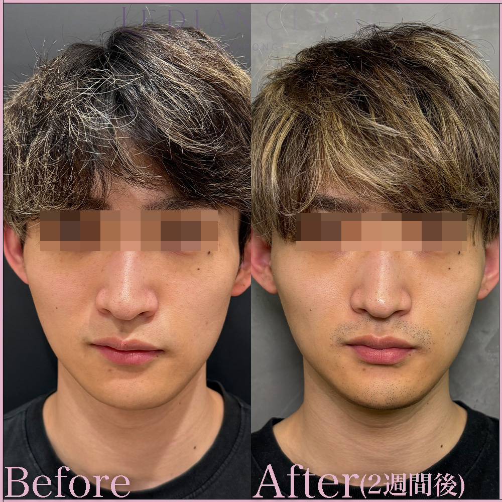 【症例Before/After】治療名:オンダプロ(ONDA PRO)
イタリア製痩身機器「ONDA PRO」を使用し、特殊なマイクロ波で脂肪細胞を加熱・分解します。
顔の脂肪(フェイスライン、二重あごなど)を減らしながら、肌の引き締め・ハリ改善も期待できます。