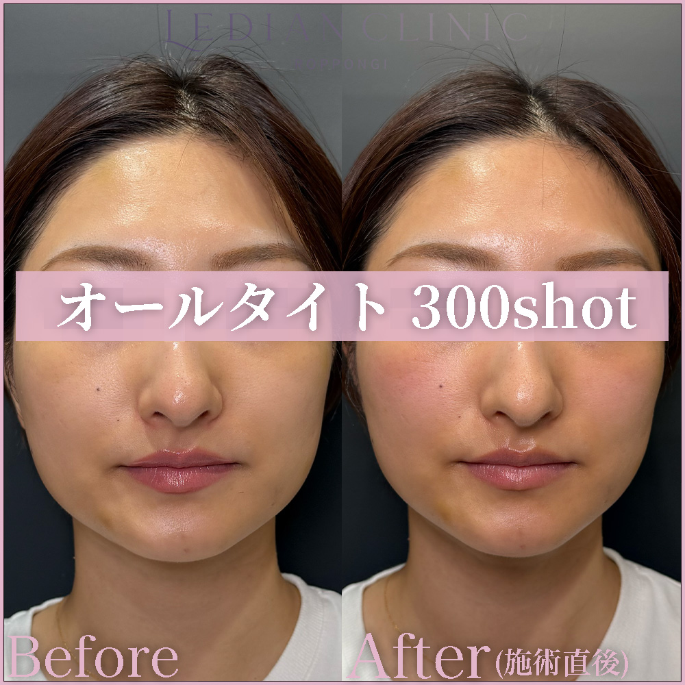 【症例Before/After】オールタイト(300shot)を両頬からこめかみ、フェイスライン際まで照射しました。DLTD®(誘電加熱)技術により、真皮層からSMAS層へ熱エネルギーを届け、コラーゲンの生成を促進しながら、フェイスラインの引き締めや頬のリフトアップ、肌のハリ・弾力の向上を目的とした治療です。
