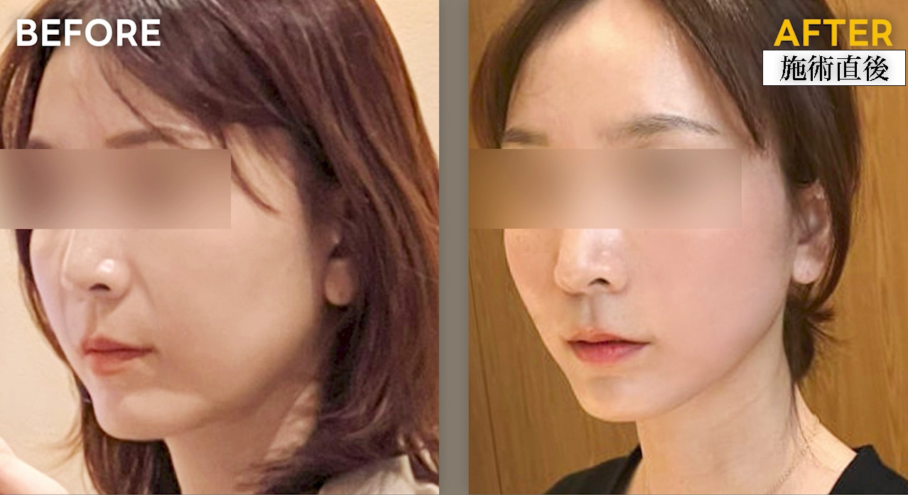 【症例Before/After】オールタイト（Alltite）は、DLTD®（誘電加熱）技術を搭載した医療機器を使用し、真皮層からSMAS層まで熱エネルギーを届けることで、フェイスラインの引き締めやリフトアップ、肌のハリ感向上を目的とした自由診療です。
ほうれい線部位 (Fractional アプリケーター)