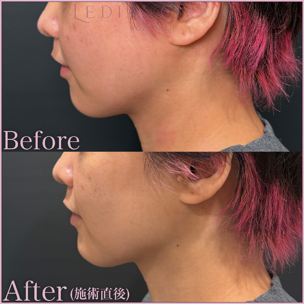 【症例Before/After】ヒアルロン酸を皮下に注入し、シワ・たるみ改善、ボリュームアップ、輪郭形成を行う施術
使用製剤:アラガン社製ヒアルロン酸(ボリューマ) 顎 0.3cc
特徴:国内承認済みのヒアルロン酸製剤
【担当医】
吉松医師