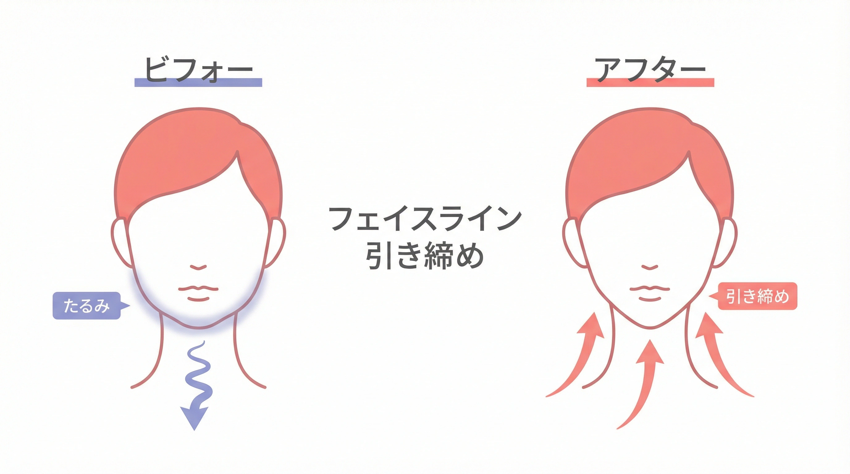 フェイスラインの引き締め効果イメージ