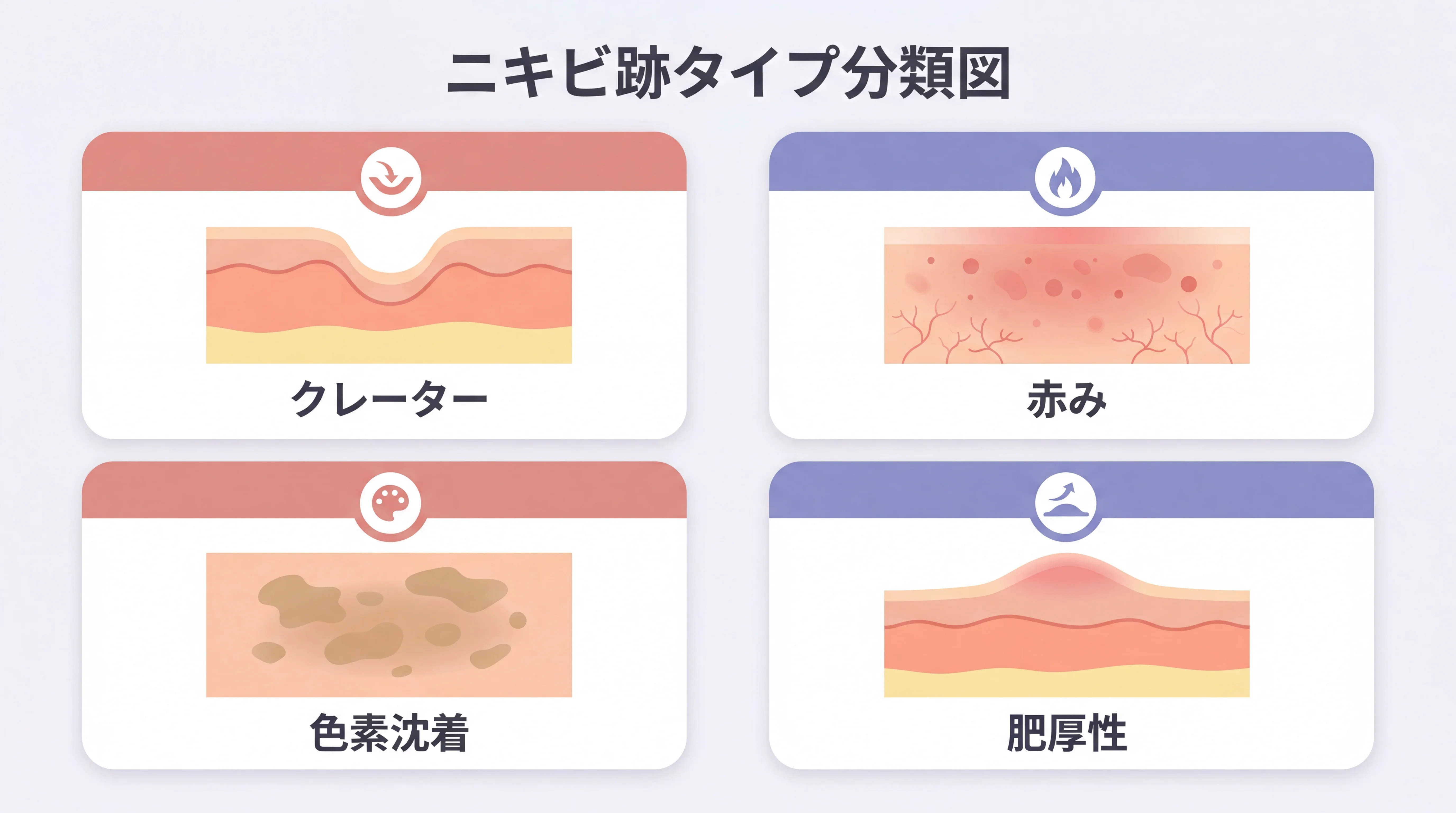クレーター、赤み、色素沈着、肥厚性瘢痕の違いを示すニキビ跡タイプ分類図