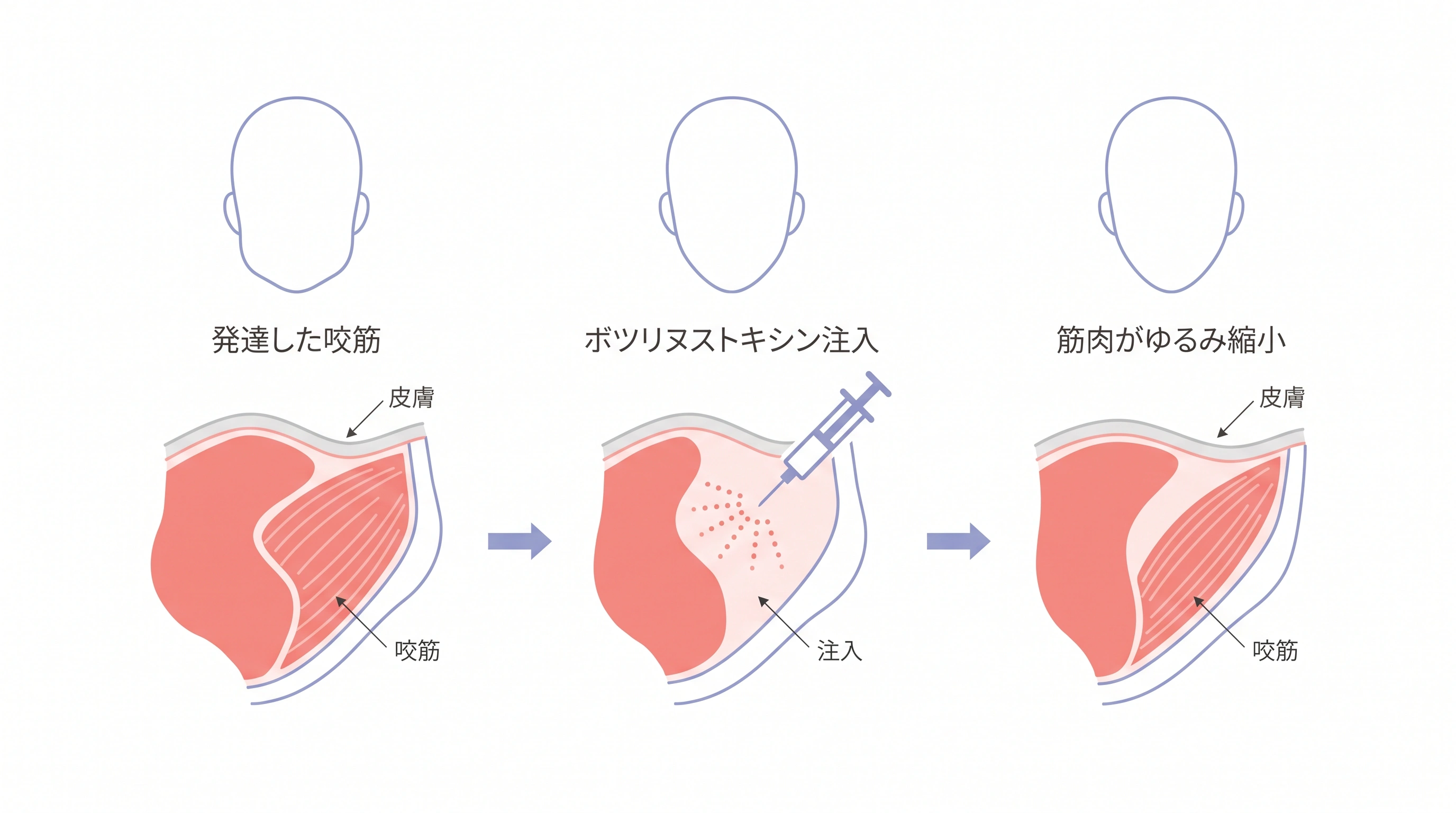エラボトックスが咬筋に作用して筋肉が縮小する仕組みの断面図