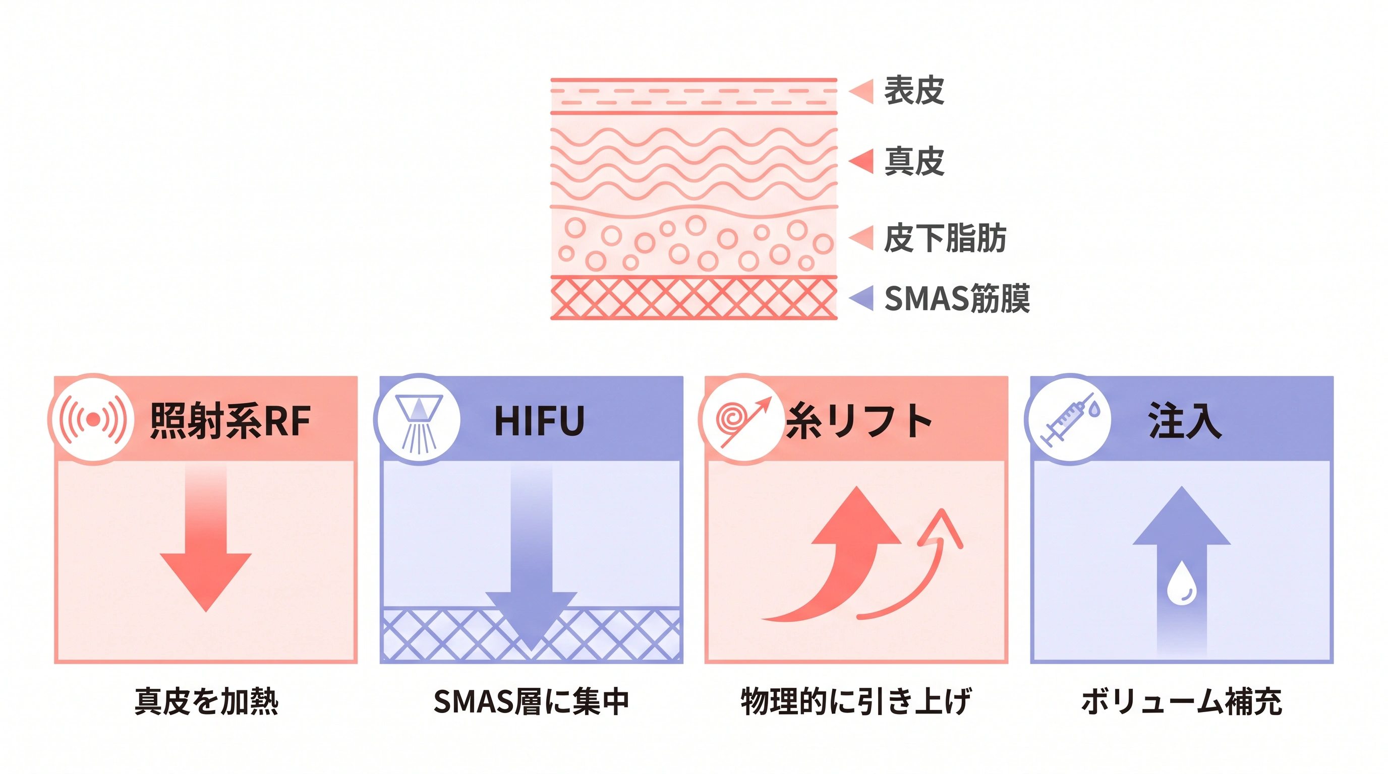 照射系RF・HIFU・糸リフト・注入が皮膚のどの層にアプローチするかを示したメカニズム比較図
