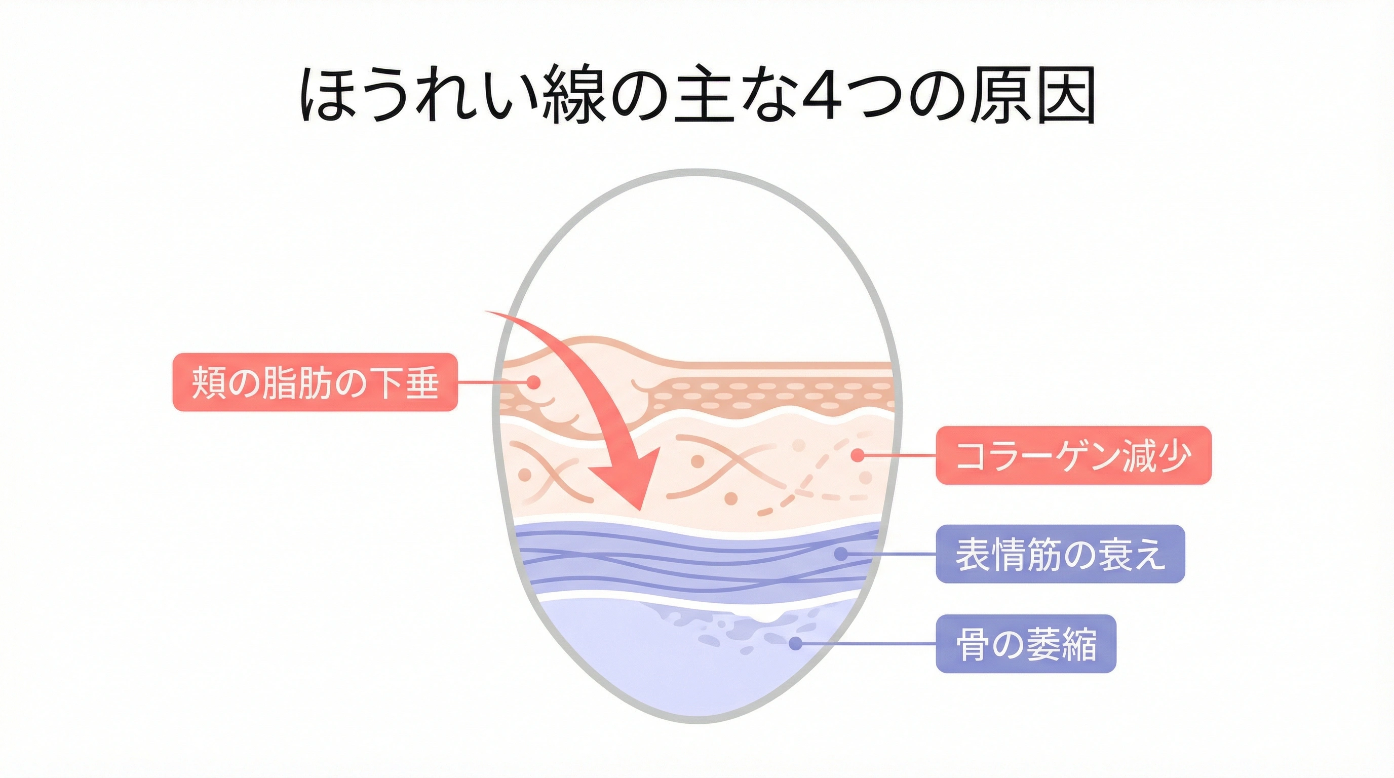 ほうれい線ができる原因の図解 - 加齢による脂肪の下垂と皮膚のたるみ