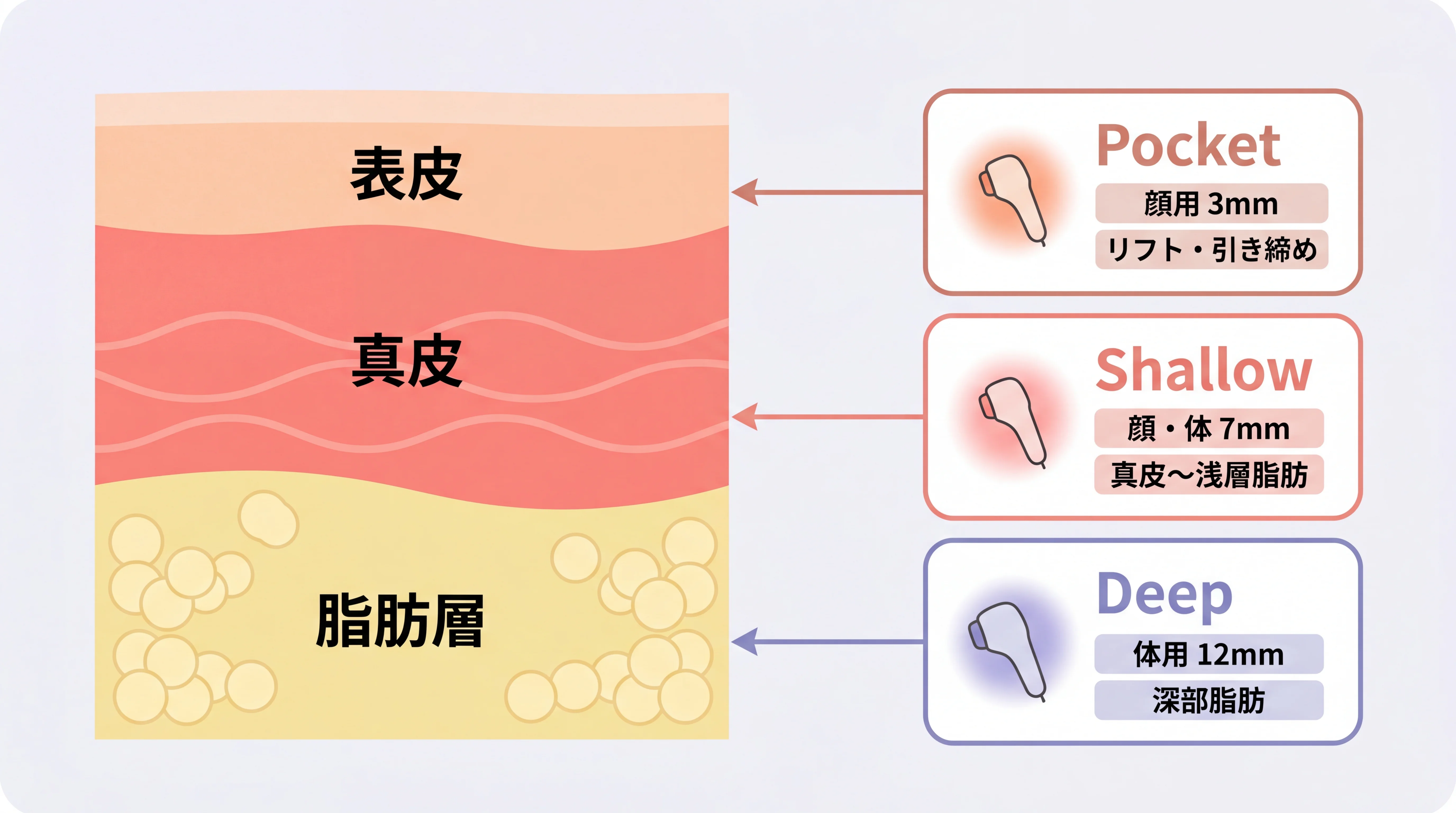 オンダプロの3つの照射ヘッド：Pocket・Shallow・Deepの層別図解と適応部位