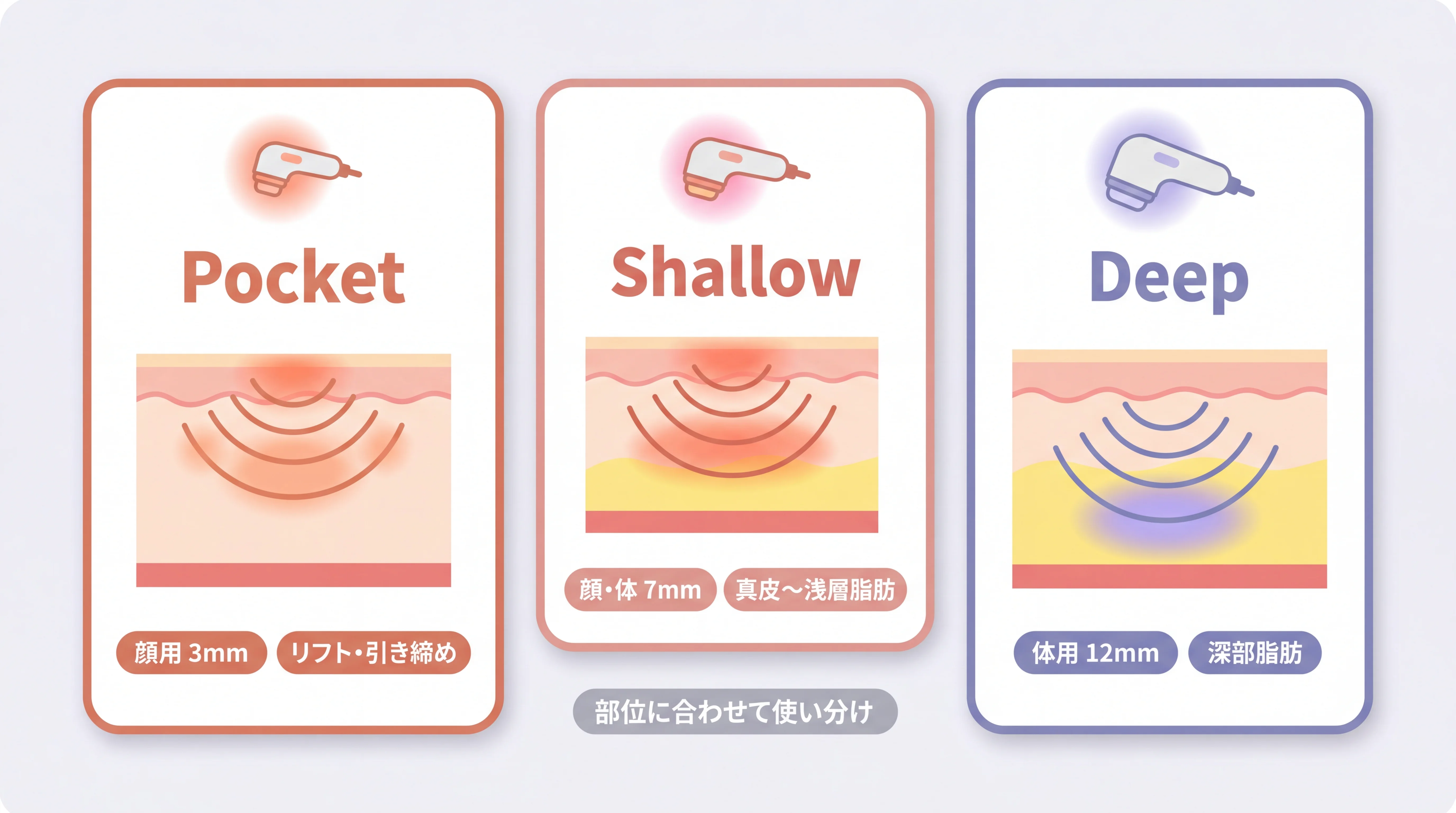 オンダリフトの照射ヘッド：Pocket・Shallow・Deepの3種と適応部位の使い分け図解