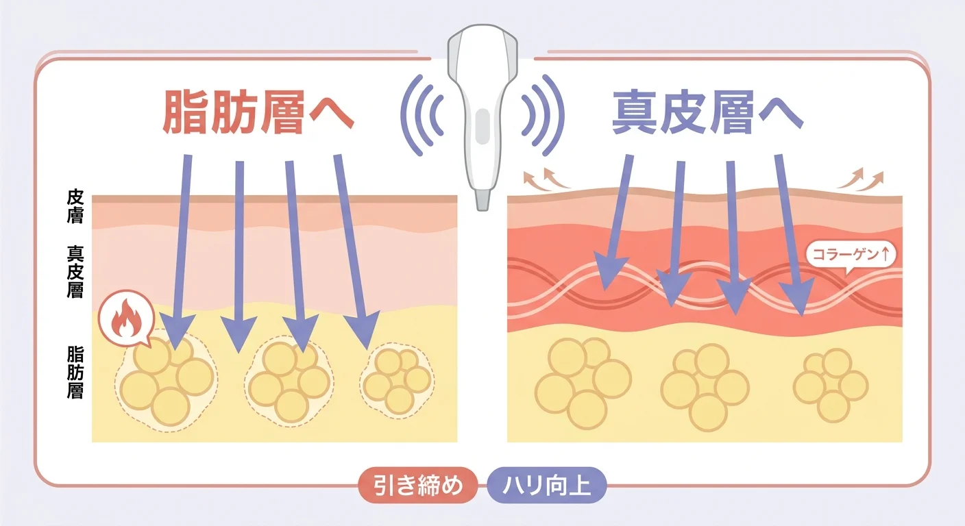 オンダリフトの二段階アプローチ：脂肪層と真皮層への仕組み図解
