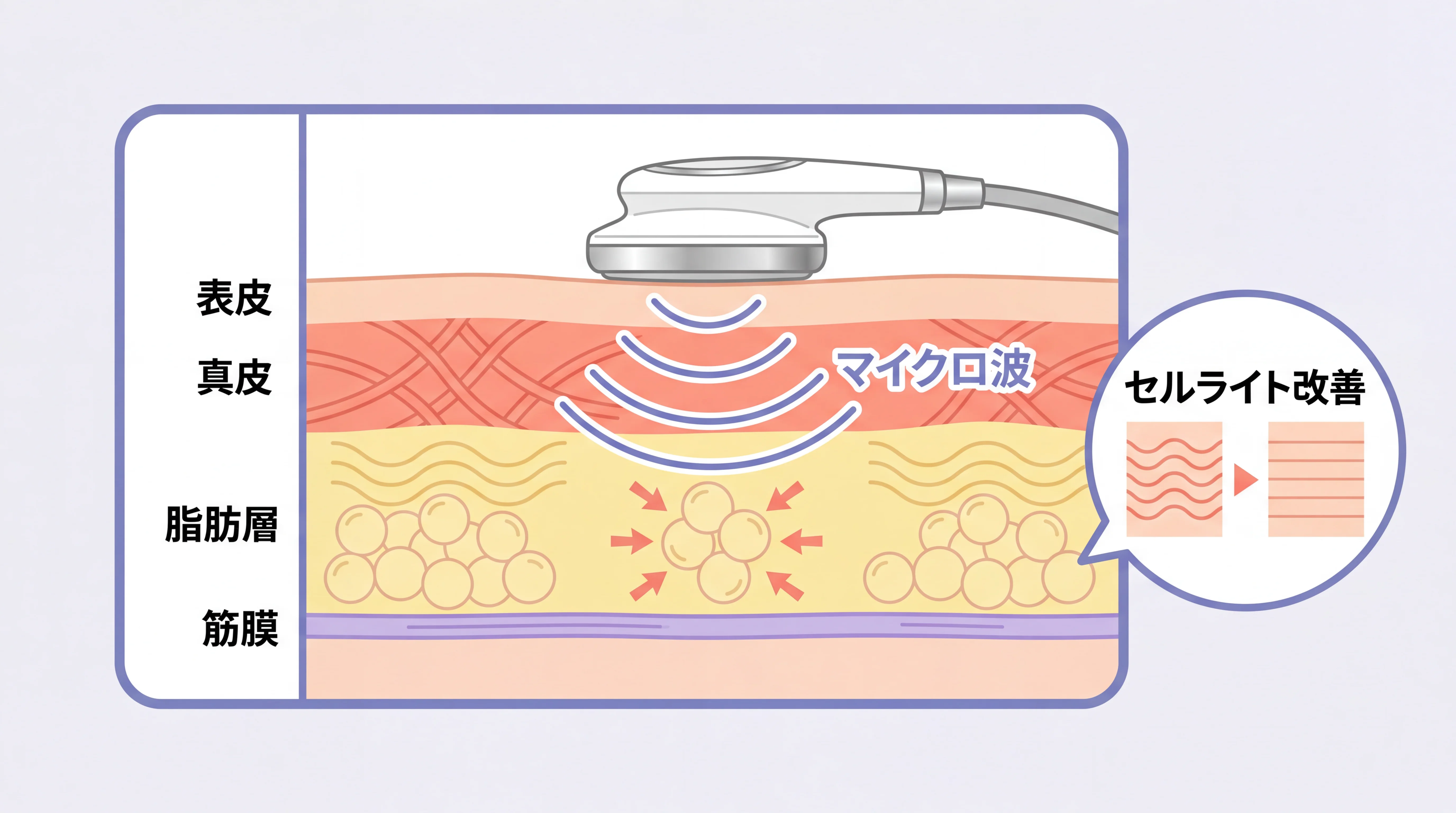 オンダリフト太ももの仕組みイメージ