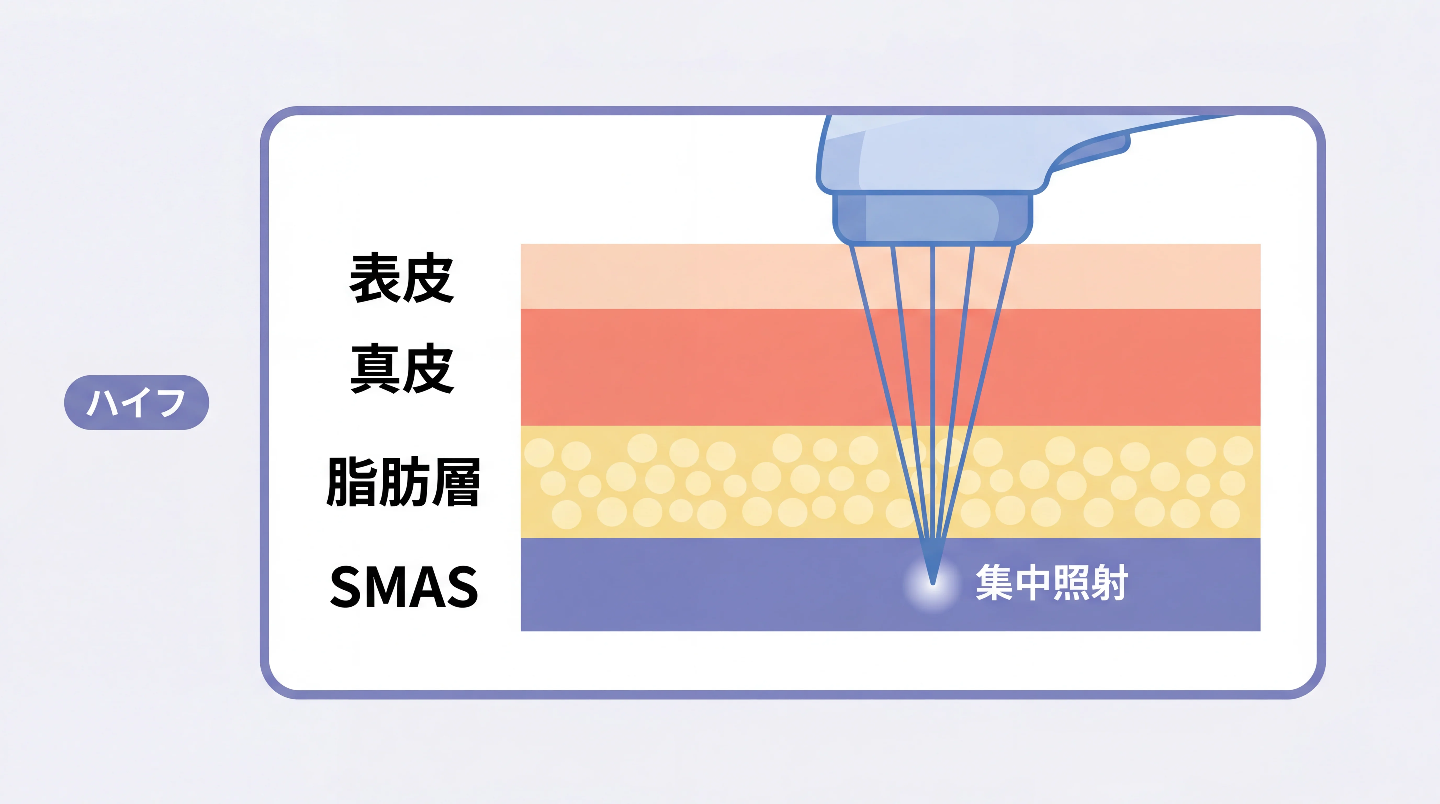ハイフの仕組み：超音波がSMAS層に集中的にエネルギーを届けるイメージ図