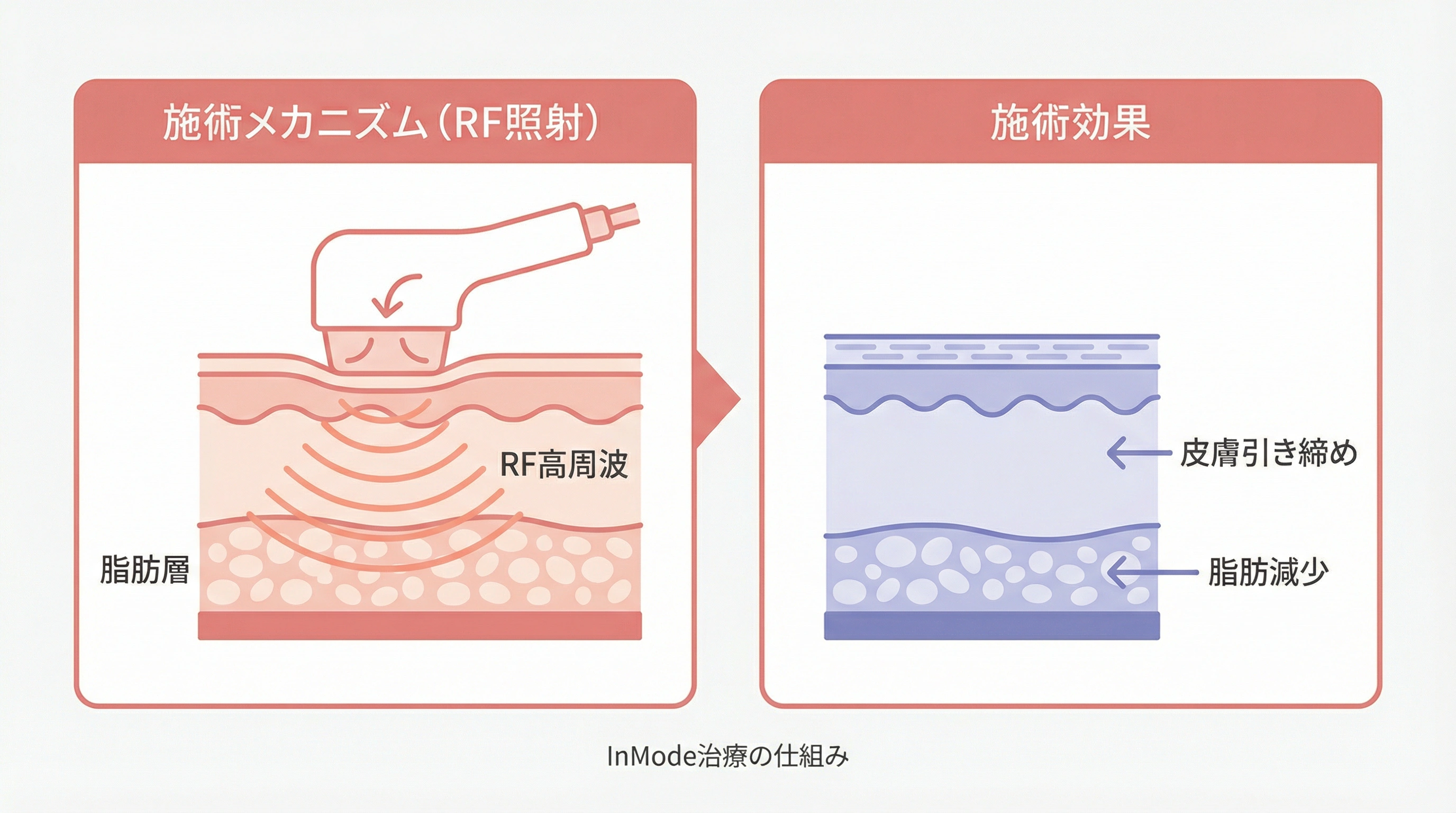 インモードの仕組み：RF高周波が脂肪層と皮膚の両方にアプローチするイメージ図