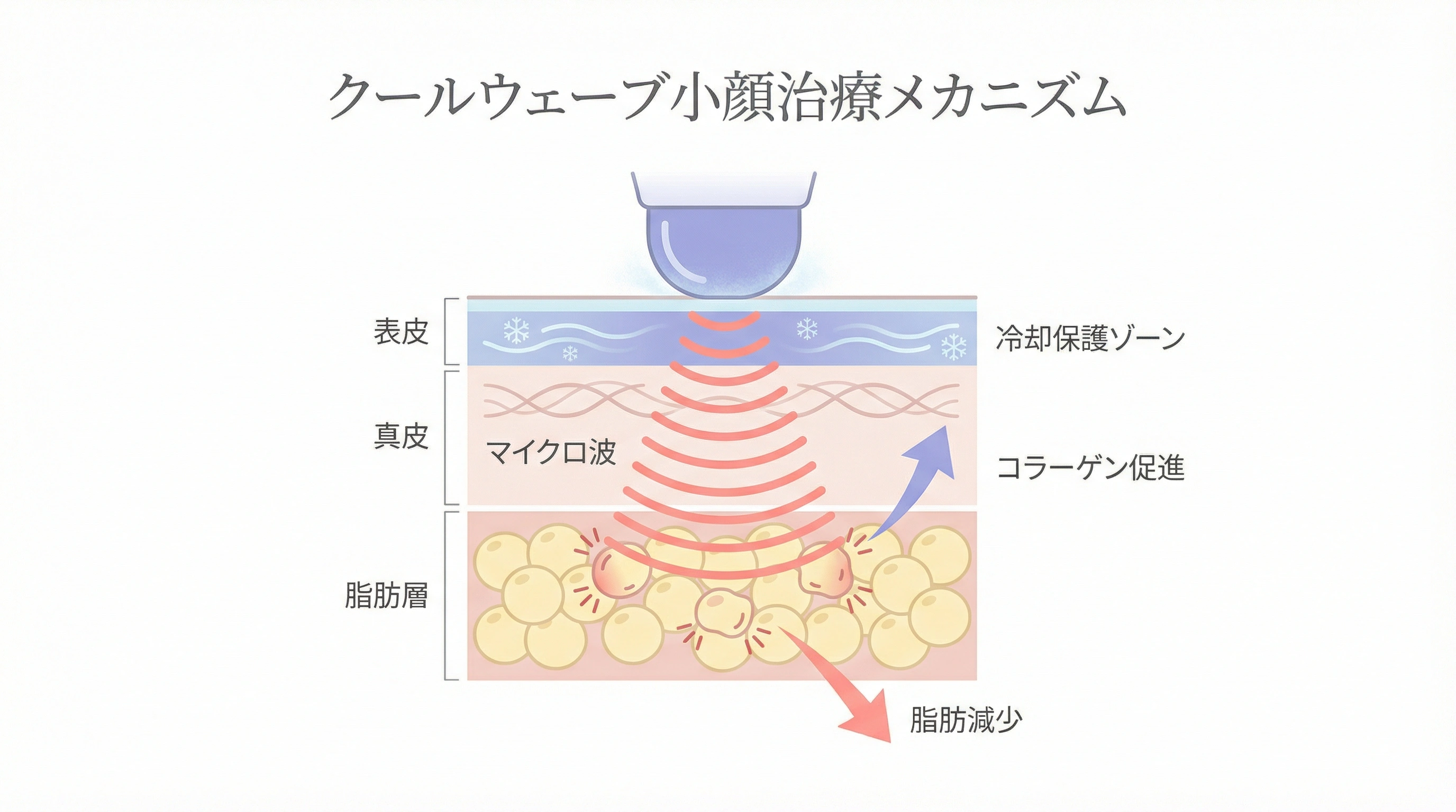 オンダリフトのCoolwavesマイクロ波が脂肪層に届くイメージ図