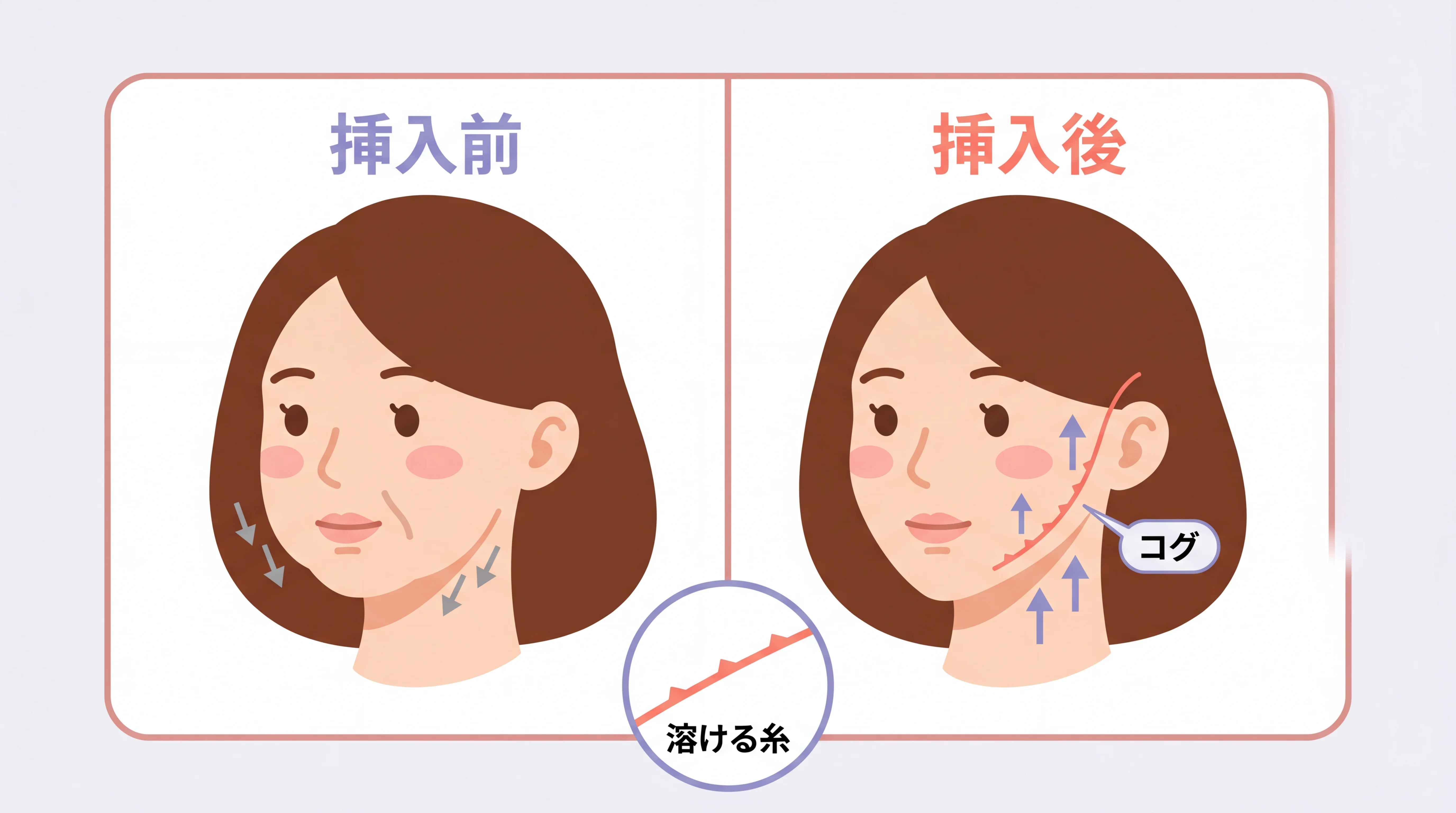 糸リフトの仕組み：コグ付きの溶ける糸でたるんだ組織を引き上げる図解